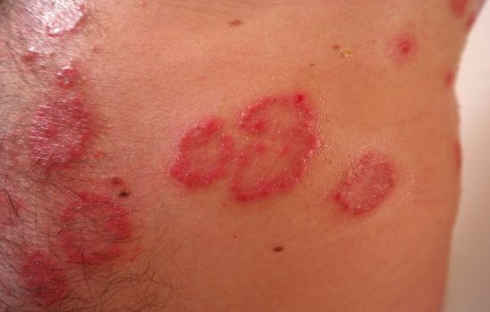psiariasis, psoriasis y sobrepeso, psoriasis y alimentación, dieta para la psoriasis