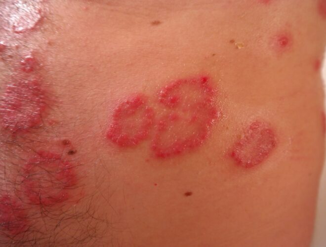 psiariasis, psoriasis y sobrepeso, psoriasis y alimentaci&oacute;n, dieta para la psoriasis