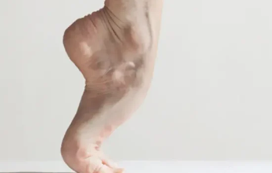 piernas de mujer adulta con varices visibles buscando vitaminas para las varices